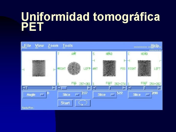 Uniformidad tomográfica PET 