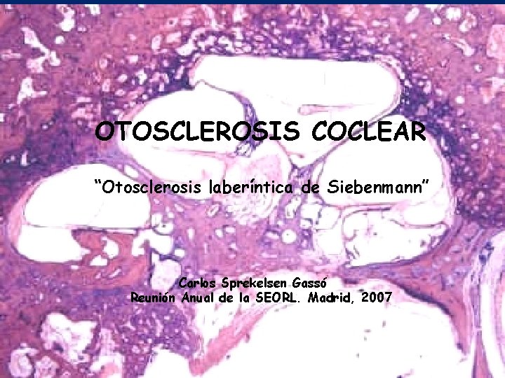 OTOSCLEROSIS COCLEAR “Otosclerosis laberíntica de Siebenmann” Carlos Sprekelsen Gassó Reunión Anual de la SEORL.