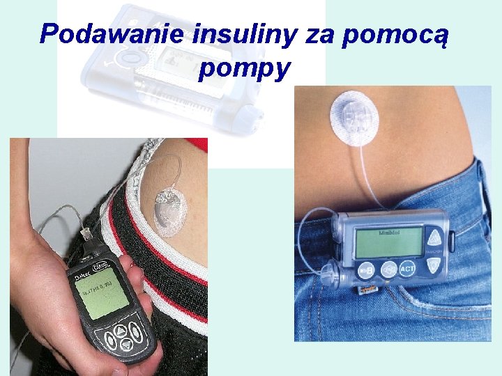 Podawanie insuliny za pomocą pompy 