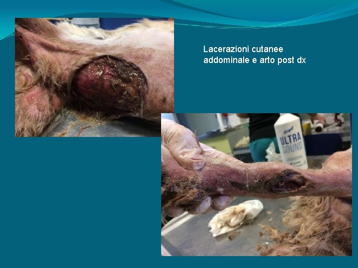 Lacerazioni cutanee addominale e arto post dx 