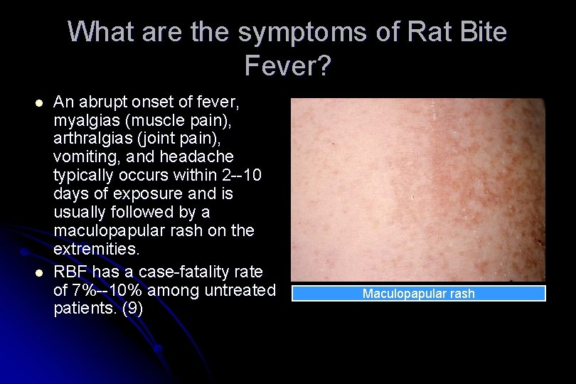 What are the symptoms of Rat Bite Fever? l l An abrupt onset of