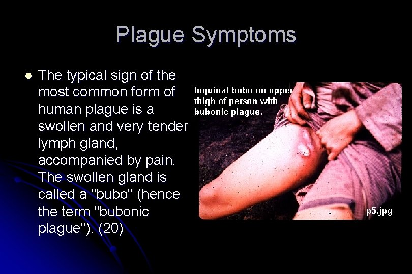 Plague Symptoms l The typical sign of the most common form of human plague