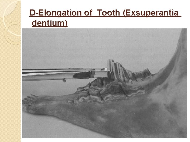 D-Elongation of Tooth (Exsuperantia dentium) 