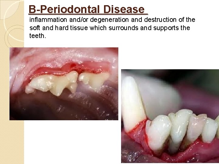 B-Periodontal Disease inflammation and/or degeneration and destruction of the soft and hard tissue which