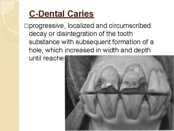 C-Dental Caries �progressive, localized and circumscribed decay or disintegration of the tooth substance with