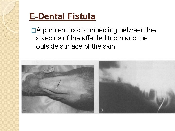 E-Dental Fistula �A purulent tract connecting between the alveolus of the affected tooth and