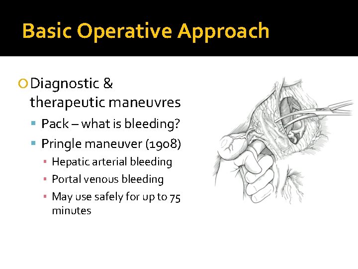 Basic Operative Approach Diagnostic & therapeutic maneuvres Pack – what is bleeding? Pringle maneuver