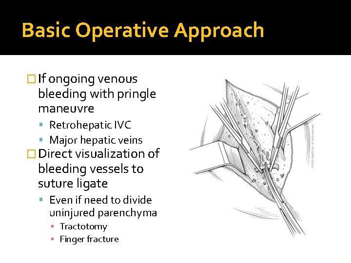 Basic Operative Approach � If ongoing venous bleeding with pringle maneuvre Retrohepatic IVC Major