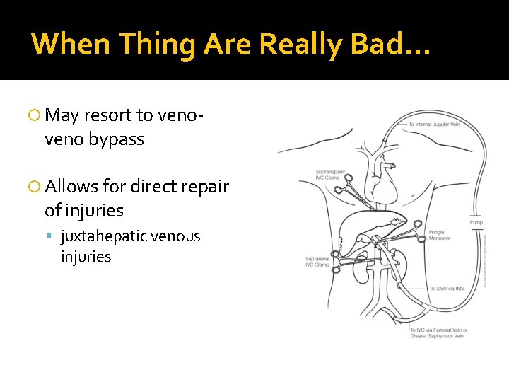 When Thing Are Really Bad… May resort to veno- veno bypass Allows for direct