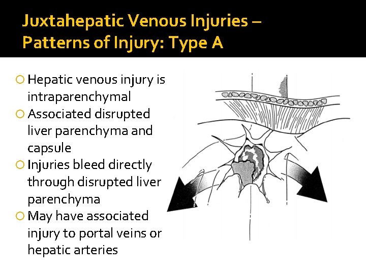 Juxtahepatic Venous Injuries – Patterns of Injury: Type A Hepatic venous injury is intraparenchymal