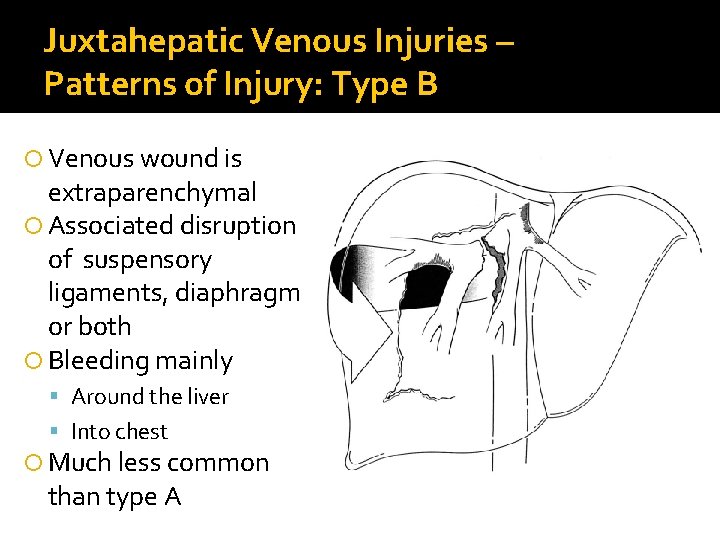 Juxtahepatic Venous Injuries – Patterns of Injury: Type B Venous wound is extraparenchymal Associated