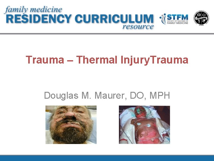 Trauma – Thermal Injury. Trauma Douglas M. Maurer, DO, MPH 