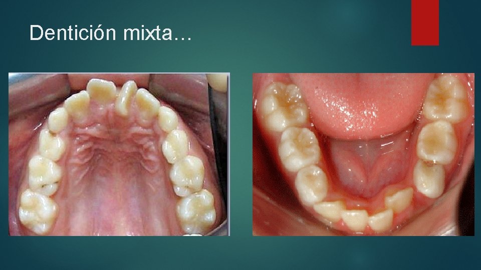 Dentición mixta… 