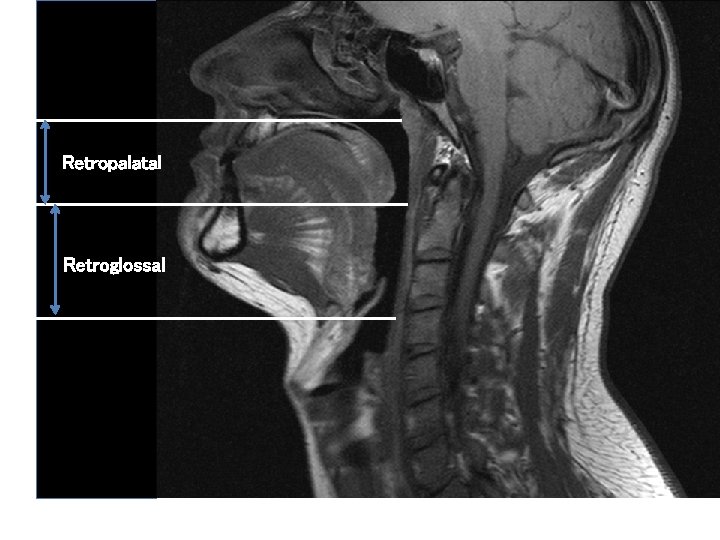 Retropalatal Retroglossal 