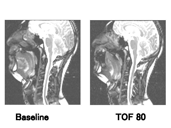 Baseline TOF 80 