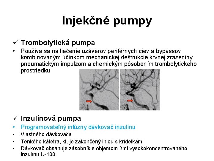 Injekčné pumpy ü Trombolytická pumpa • Používa sa na liečenie uzáverov periférnych ciev a