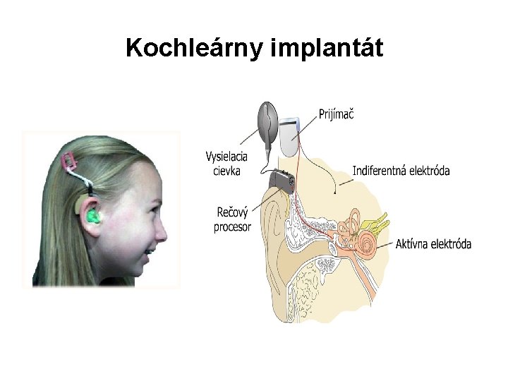 Kochleárny implantát 