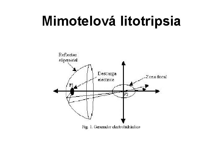 Mimotelová litotripsia 
