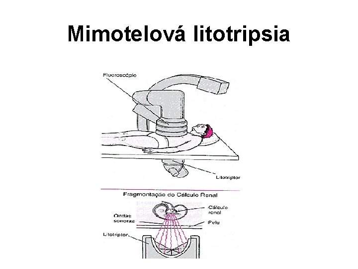 Mimotelová litotripsia 