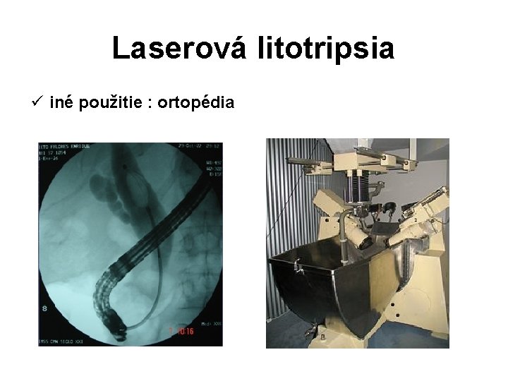 Laserová litotripsia ü iné použitie : ortopédia 
