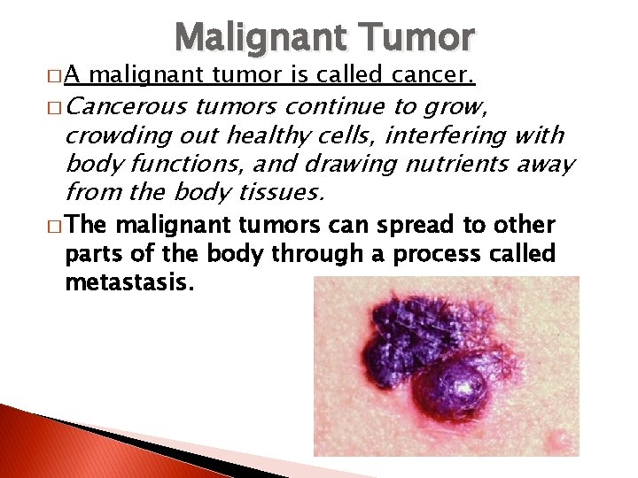 �A Malignant Tumor malignant tumor is called cancer. � Cancerous tumors continue to grow,