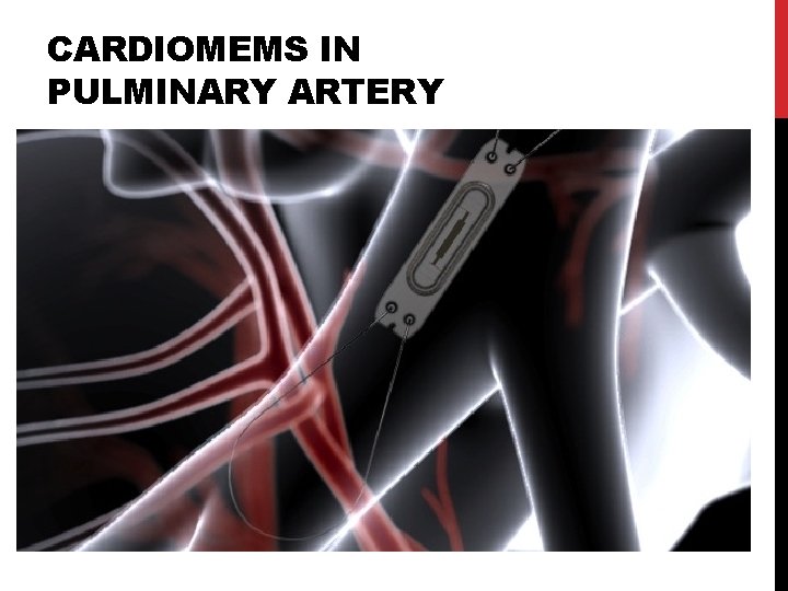 CARDIOMEMS IN PULMINARY ARTERY CARDIOMEMS IN PULMINARY ARTERY