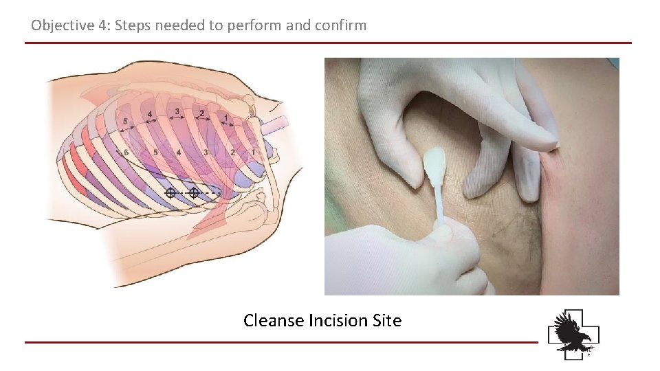 Objective 4: Steps needed to perform and confirm Cleanse Incision Site Objective 4: Steps needed to perform and confirm Cleanse Incision Site