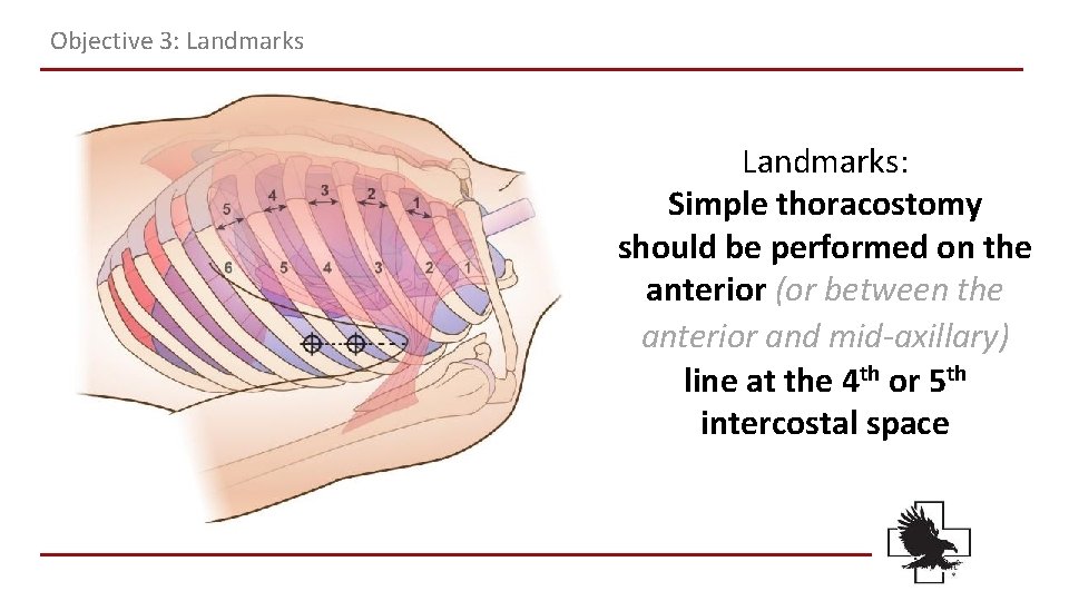 Objective 3: Landmarks: Simple thoracostomy should be performed on the anterior (or between the Objective 3: Landmarks: Simple thoracostomy should be performed on the anterior (or between the