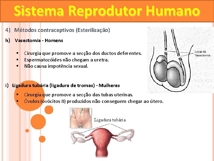 Sistema Reprodutor Humano 4) Métodos contraceptivos (Esterilização) h) Vasectomia - Homens § § §