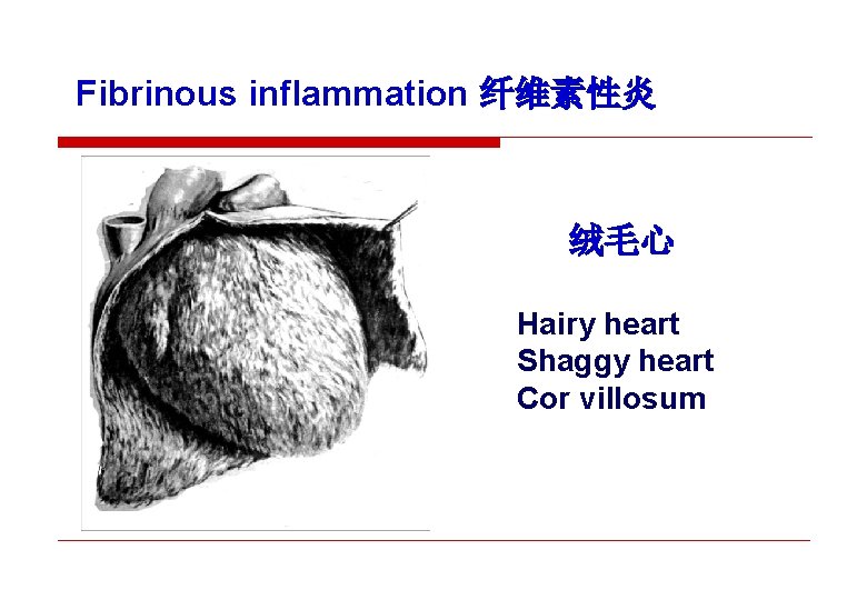 Fibrinous inflammation 纤维素性炎 绒毛心 Hairy heart Shaggy heart Cor villosum 