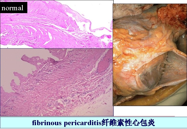 normal fibrinous pericarditis纤维素性心包炎 