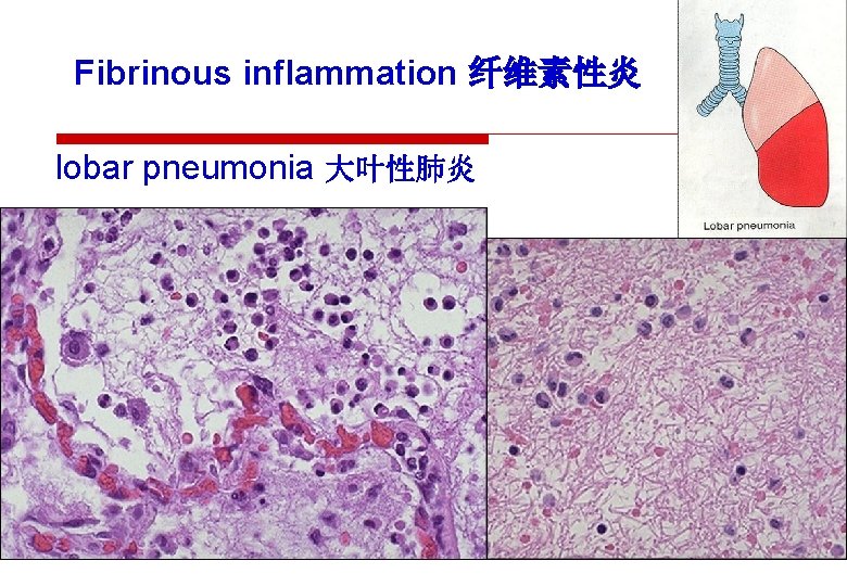 Fibrinous inflammation 纤维素性炎 lobar pneumonia 大叶性肺炎 