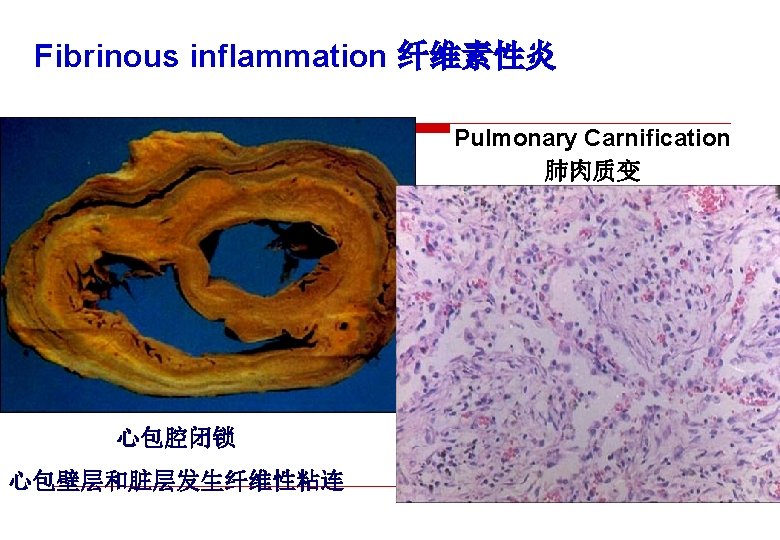 Fibrinous inflammation 纤维素性炎 Pulmonary Carnification 肺肉质变 心包腔闭锁 心包壁层和脏层发生纤维性粘连 