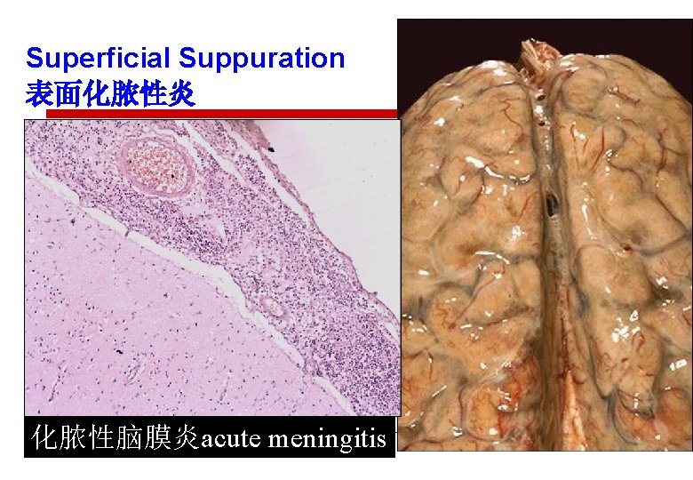 Superficial Suppuration 表面化脓性炎 化脓性脑膜炎acute meningitis 