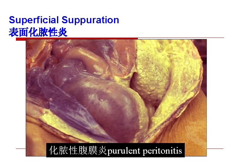 Superficial Suppuration 表面化脓性炎 化脓性腹膜炎purulent peritonitis 