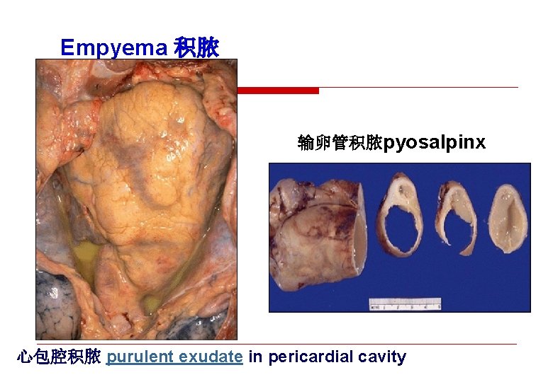 Empyema 积脓 输卵管积脓pyosalpinx 心包腔积脓 purulent exudate in pericardial cavity 