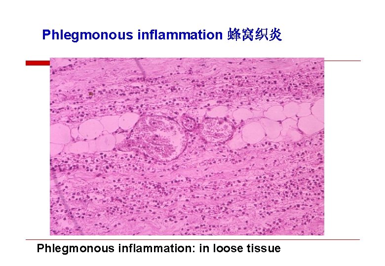 Phlegmonous inflammation 蜂窝织炎 Phlegmonous inflammation: in loose tissue 