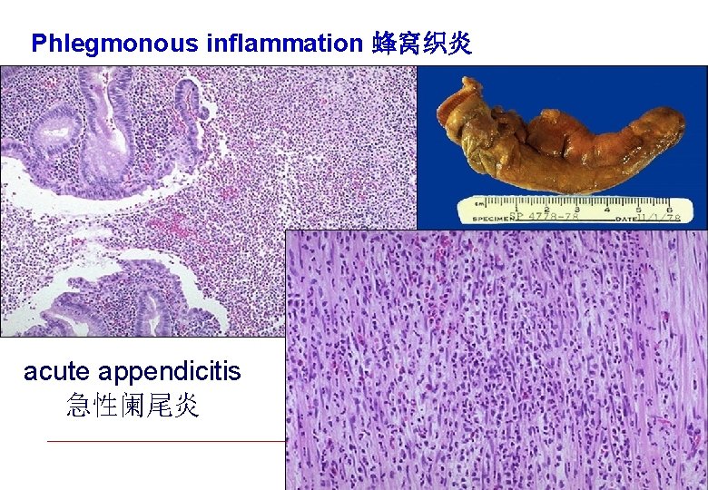 Phlegmonous inflammation 蜂窝织炎 acute appendicitis 急性阑尾炎 