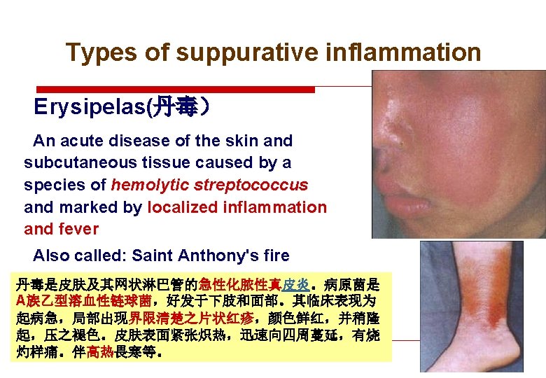 Types of suppurative inflammation Erysipelas(丹毒） An acute disease of the skin and subcutaneous tissue