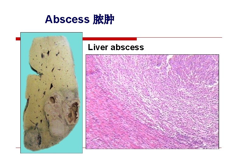 Abscess 脓肿 Liver abscess 