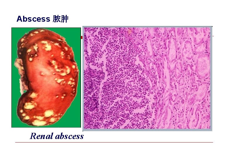 Abscess 脓肿 Renal abscess 