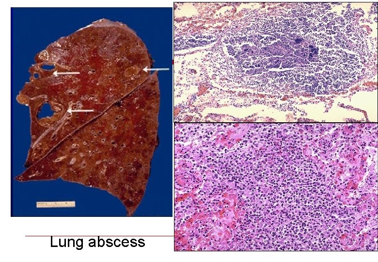 Lung abscess 