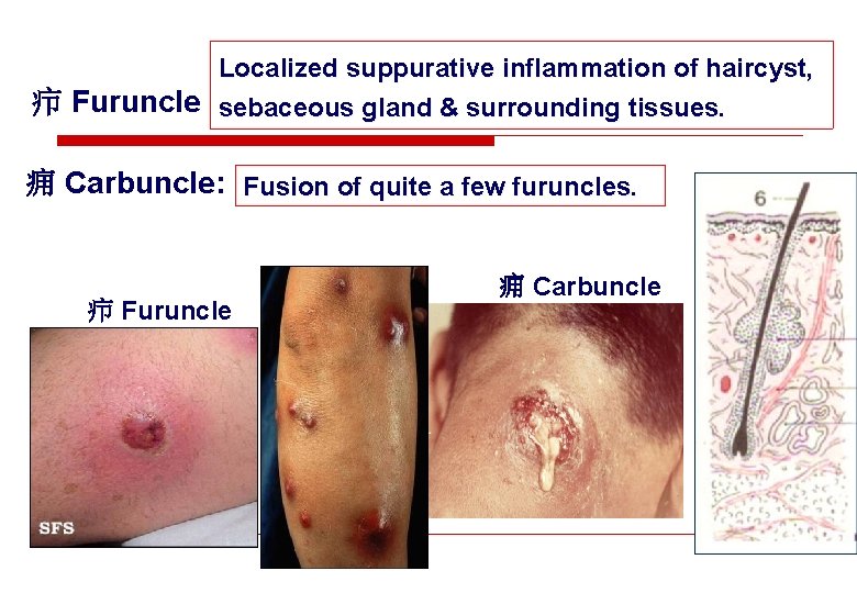 Localized suppurative inflammation of haircyst, 疖 Furuncle sebaceous gland & surrounding tissues. 痈 Carbuncle: