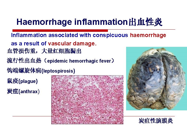 Haemorrhage inflammation出血性炎 Inflammation associated with conspicuous haemorrhage as a result of vascular damage. 血管损伤重，大量红细胞漏出