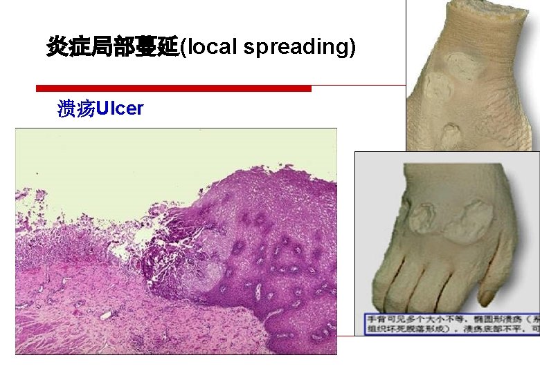 炎症局部蔓延(local spreading) 溃疡Ulcer 