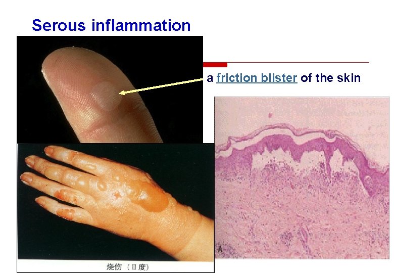 Serous inflammation a friction blister of the skin 