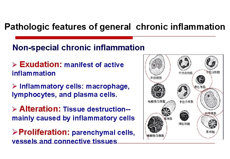 Pathologic features of general chronic inflammation Non-special chronic inflammation Ø Exudation: manifest of active