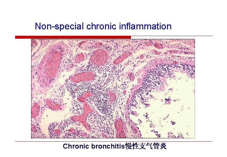 Non-special chronic inflammation Chronic bronchitis慢性支气管炎 