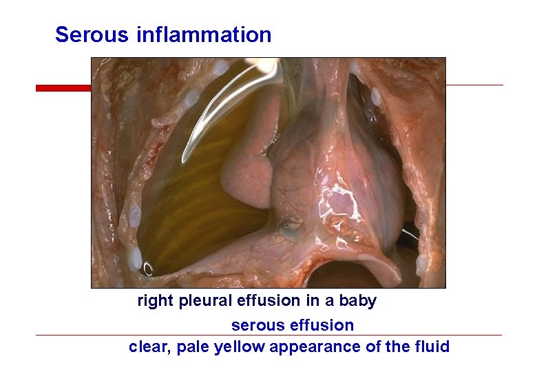 Serous inflammation right pleural effusion in a baby serous effusion clear, pale yellow appearance