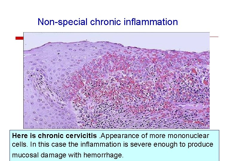 Non-special chronic inflammation Here is chronic cervicitis. Appearance of more mononuclear cells. In this